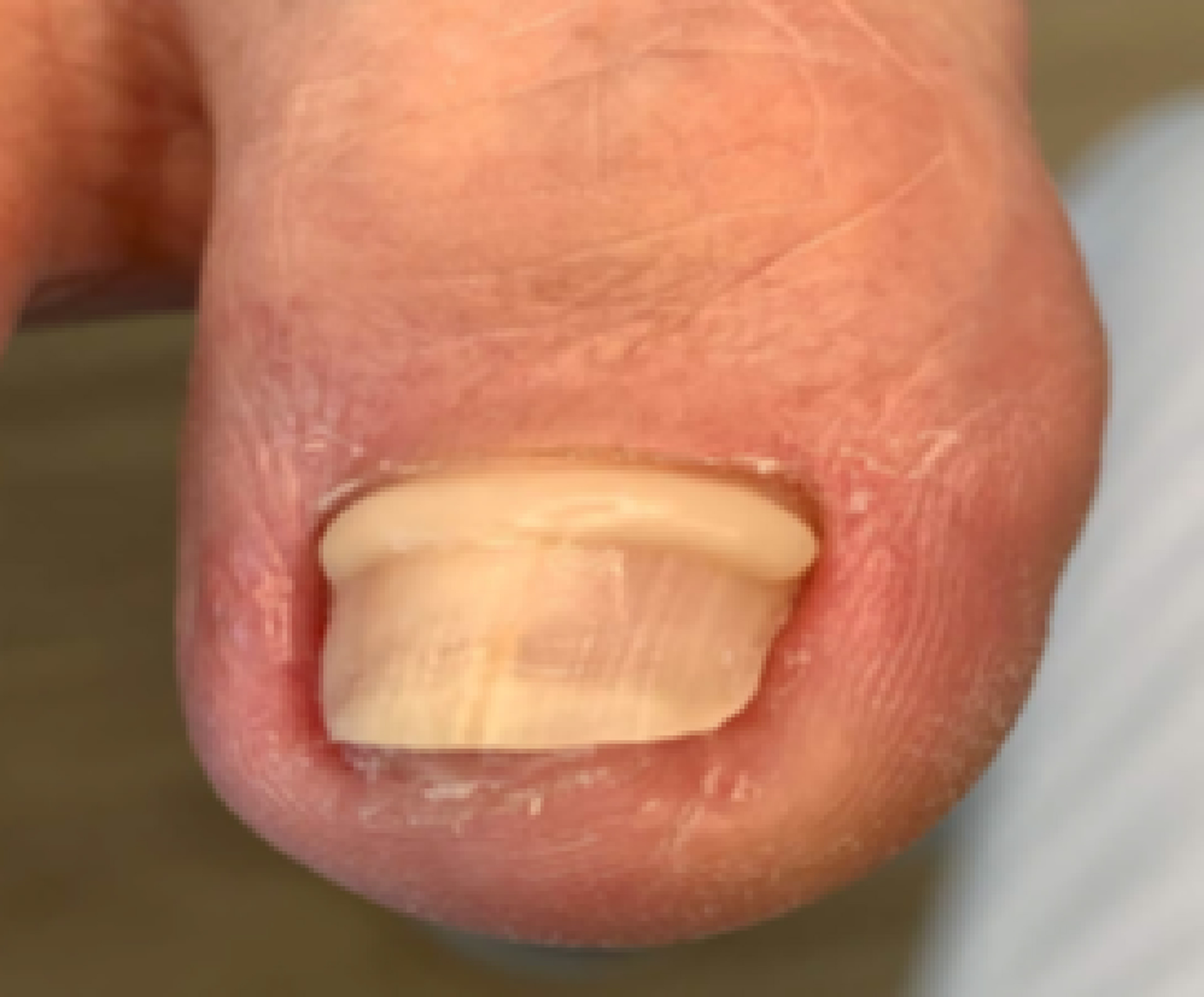 UNGUISAN Blue Light Gel Hart | Composite Gel 4 g